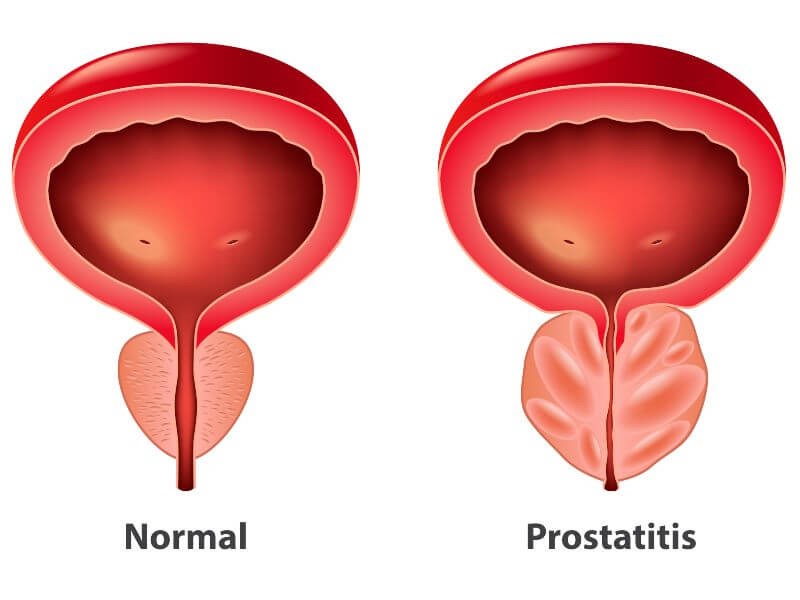 التهاب البروستاتا