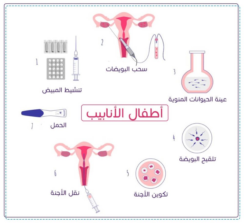 خطوات عملية أطفال الأنابيب