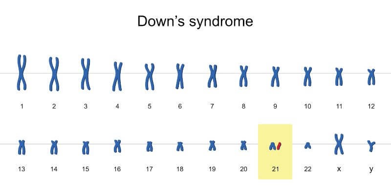 متلازمة داون