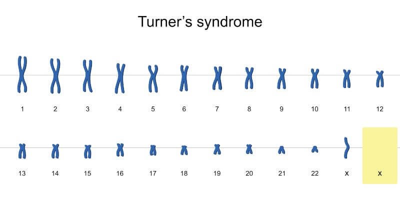 متلازمة تيرنر