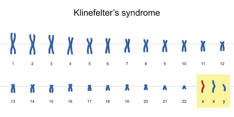 متلازمة كلاينفلتر