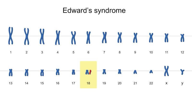 متلازمة إدوارد