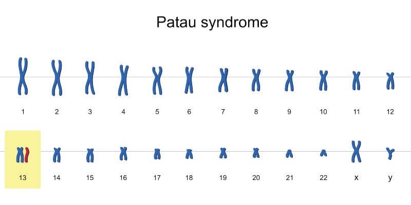 متلازمة باتاو