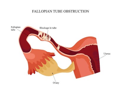 fallopian tubes verwachsungen blocked blockage falopi tuba eileiter tubal endometriosis entfernung schwanger sieht mejorar ricino paquete fertilidad reproductive fertility orami