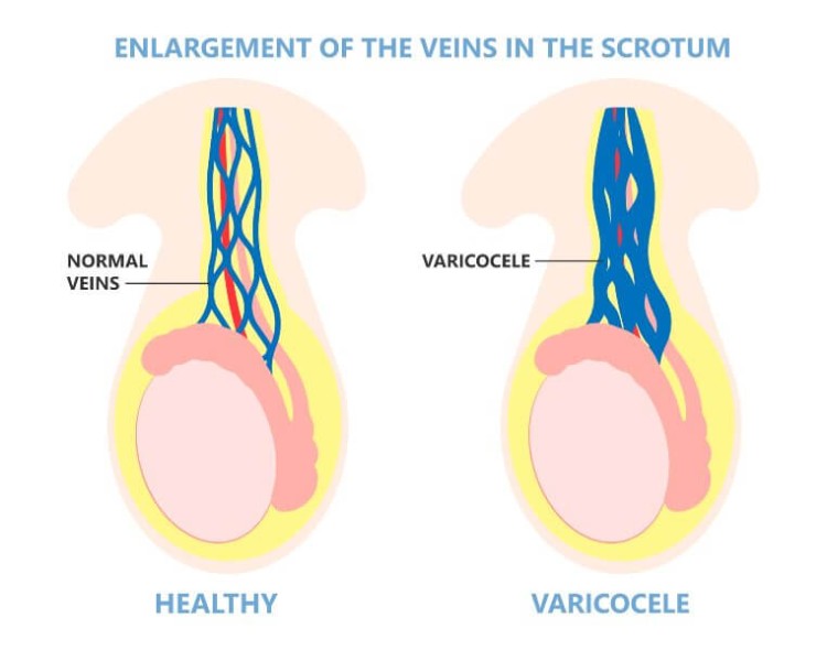 varicocele 