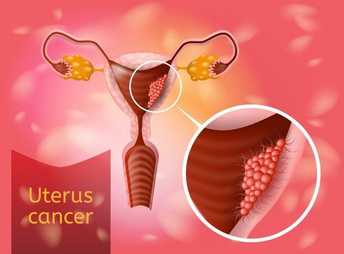 مراحل سرطان الرحم