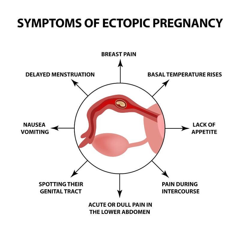 signs of ectopic pregnancy