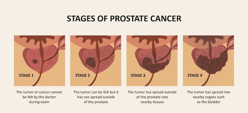 the 4 stages of prostate cancer