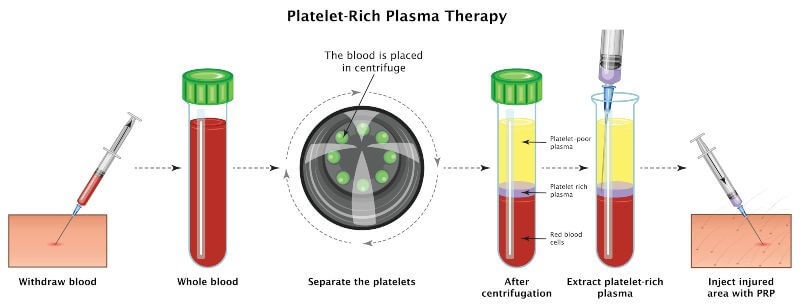 PRP injection in the penis steps