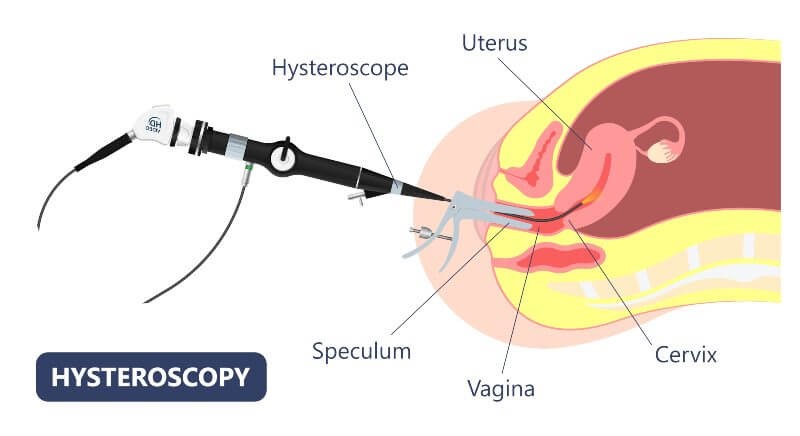 description of hysteroscopy surgery