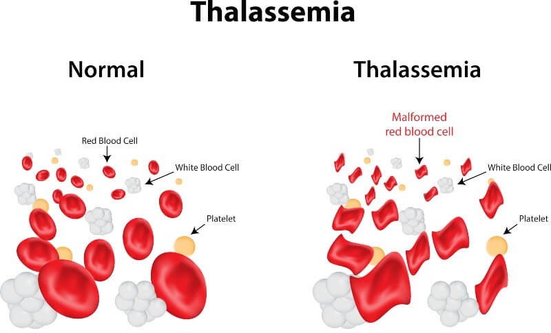 Difference between normal blood and thalassemia