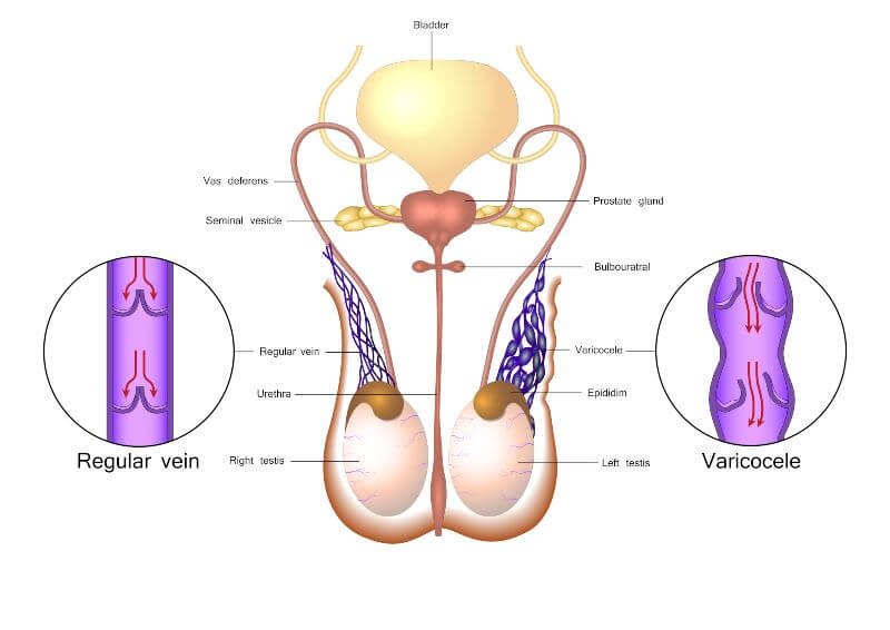 difference between normal vein and varicocele