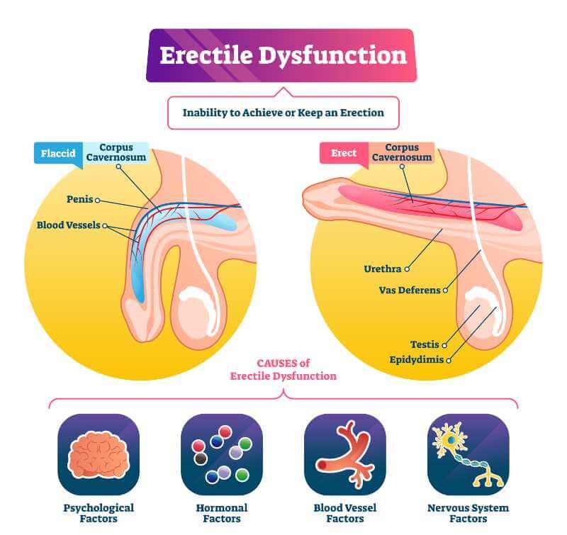 Erectile dysfunction (ED) causes