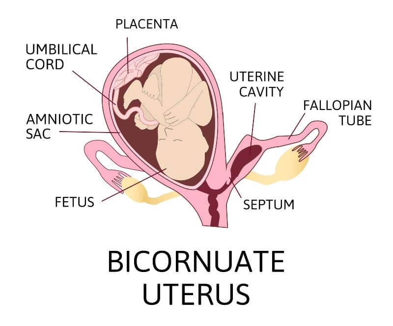 uterus bicornis and pregnancy