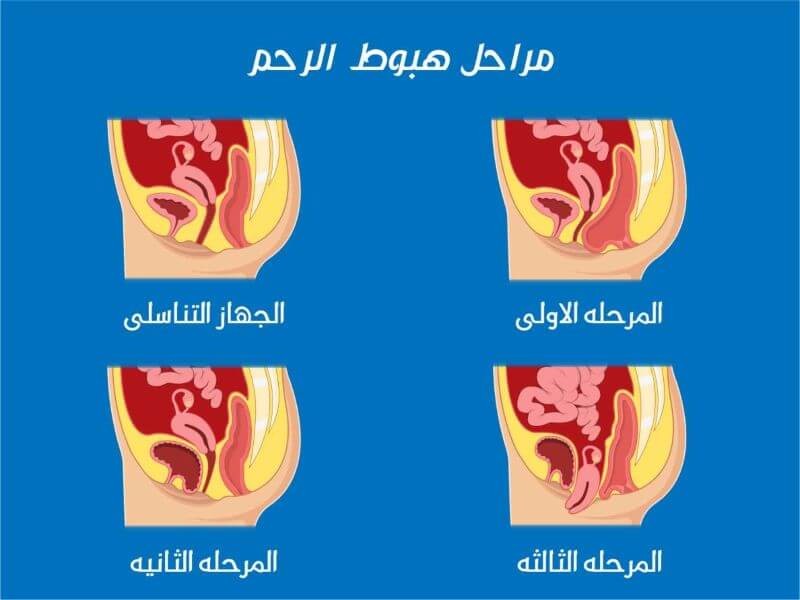 مراحل هبوط الرحم