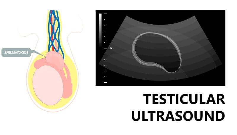 Testicular doppler ultrasound