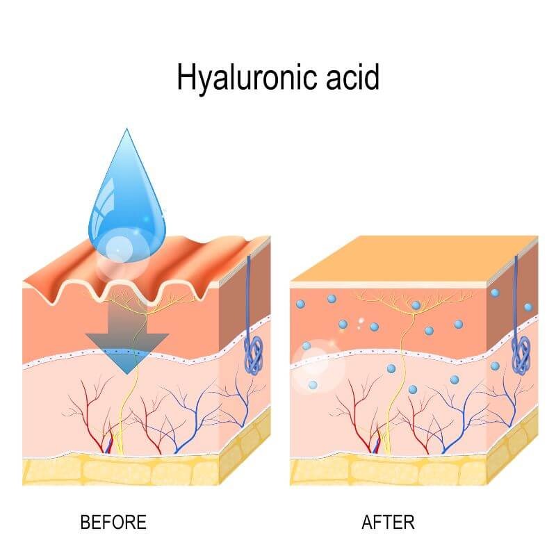 Hyaluronic acid injections for premature ejaculation