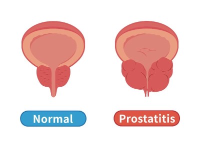 calcul prosztatitis)
