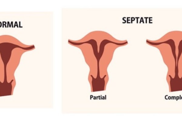 هل يؤثر الرحم ذو القرنين على نسب حدوث الحمل ؟
