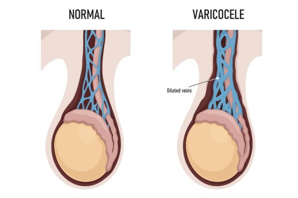 Varicocele treatment without surgery