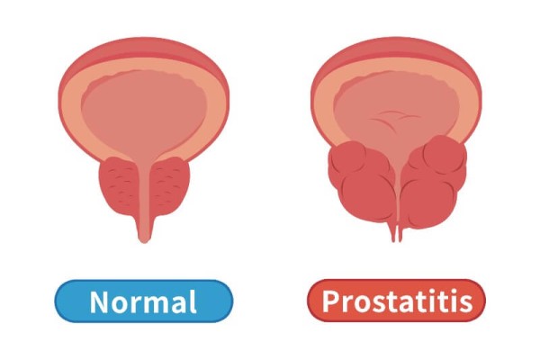 Prostatitis: symptoms, causes, and treatment