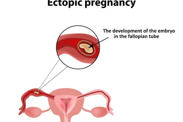 Ectopic pregnancy - Can an ectopic pregnancy be saved?
