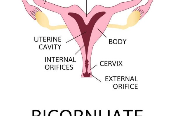 Uterus bicornis (Bicornuate uterus)