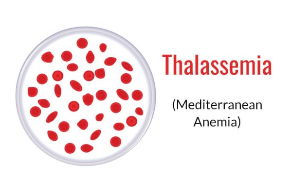 Thalassemia (Mediterranean anemia): Causes, and treatment