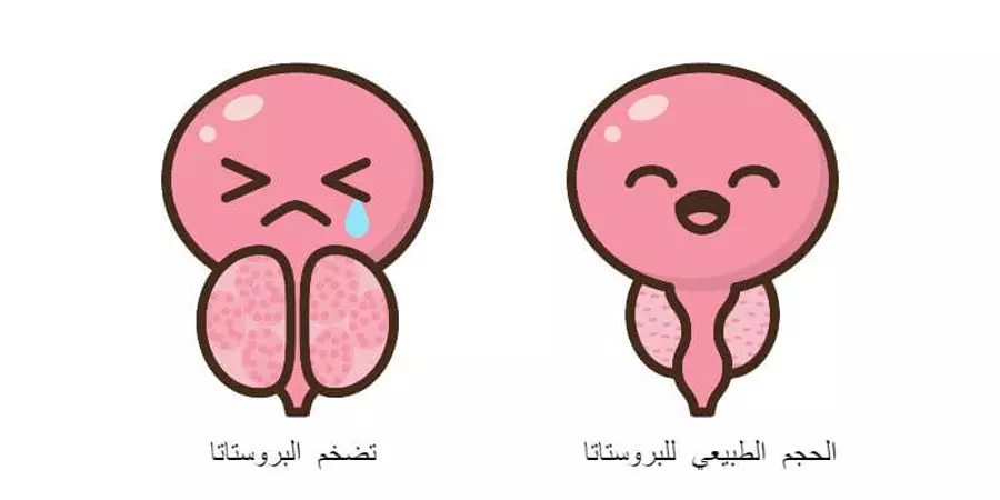 تضخم البروستاتا الحميد 