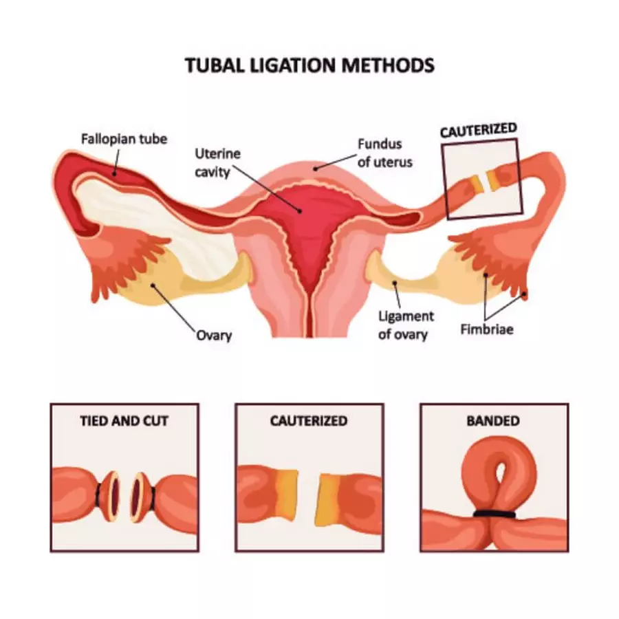 عملية ربط قنوات فالوب لمنع الحمل