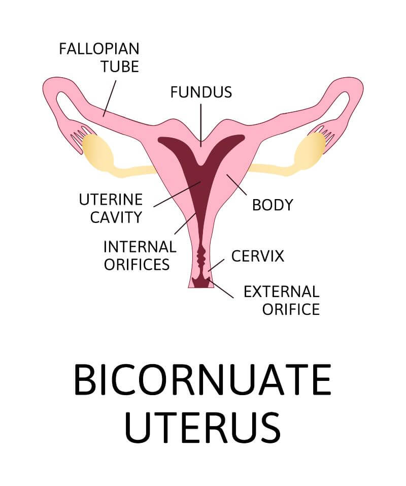 Uterus bicornis (Bicornuate uterus)