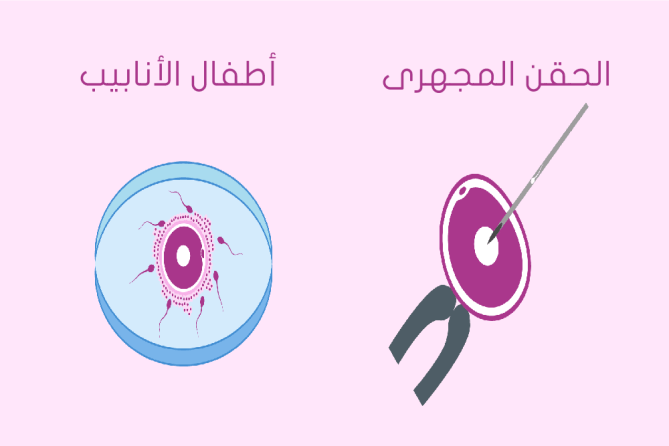 الفرق بين الحقن المجهري واطفال الانابيب