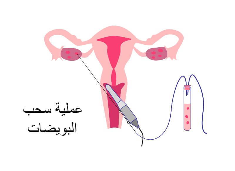 عملية سحب البويضات