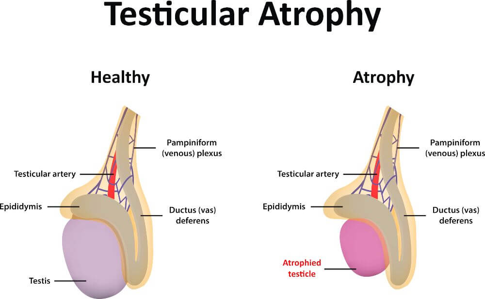 ضمور الخصية -الأعراض والأسباب والعلاج