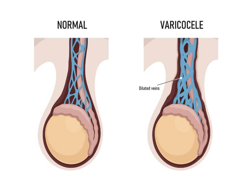 Varicocele treatment without surgery