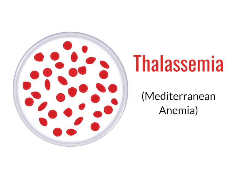 Thalassemia (Mediterranean anemia): Causes, and treatment