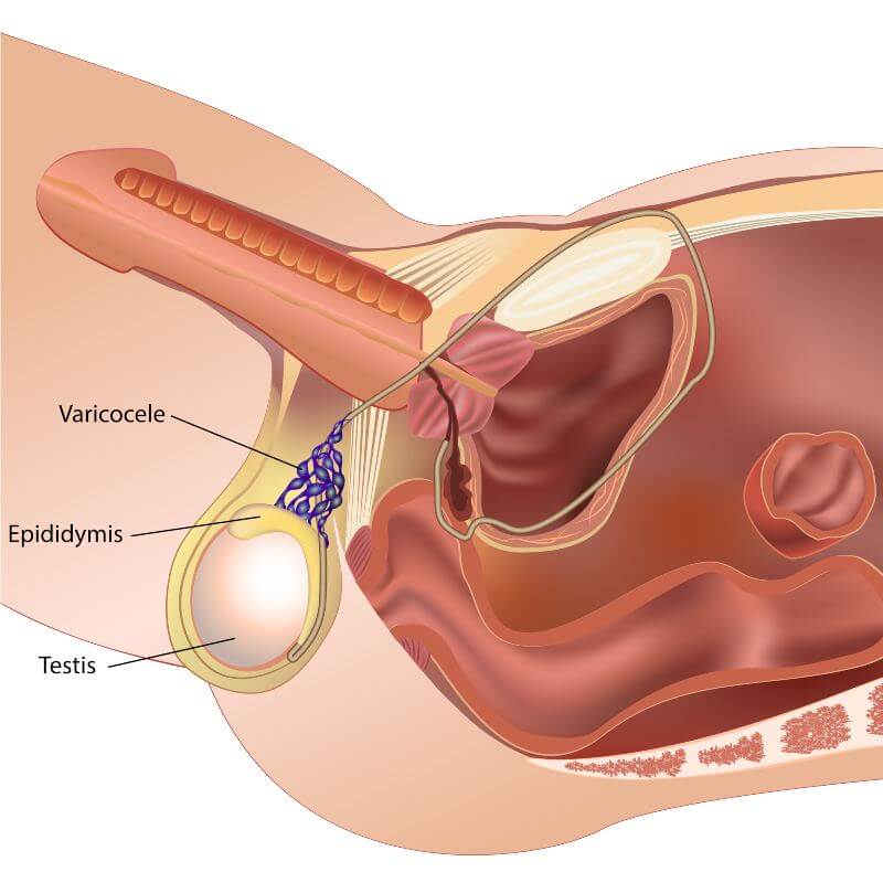 Do Varicoceles Cause Infertility?